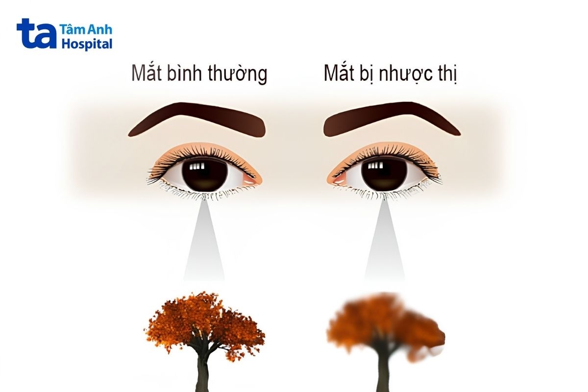 Ở trẻ em và thanh thiếu niên, không đeo kính khi bị cận thị kéo dài có thể làm tăng nguy cơ nhược thị và lác mắt do mắt phải thường xuyên nhìn trong tình trạng mờ.