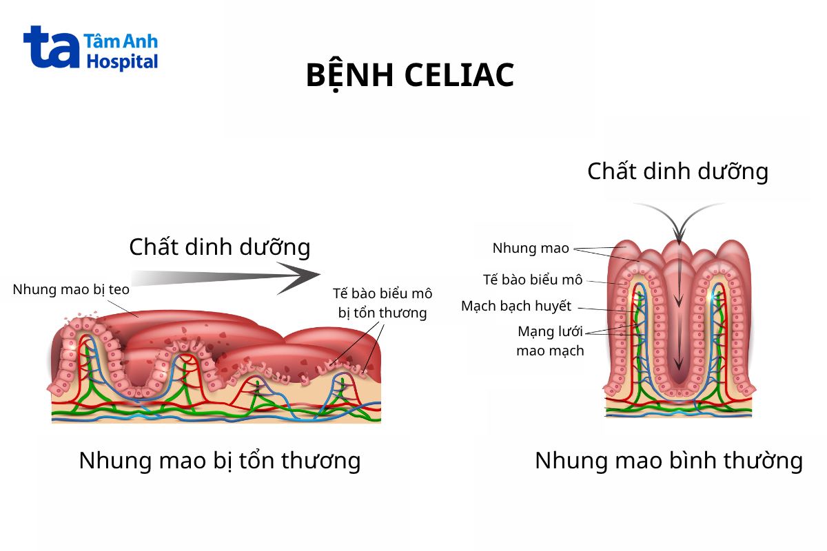 phản ứng với gluten