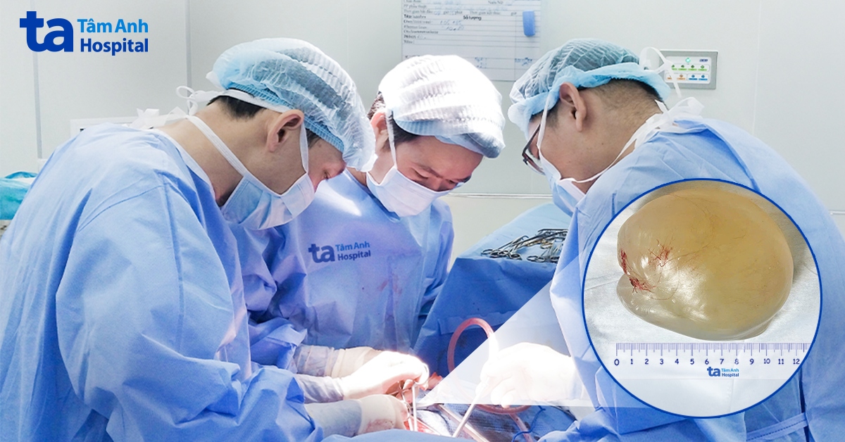 Khối nang bằng quả bưởi trong bìu suýt làm teo tinh hoàn