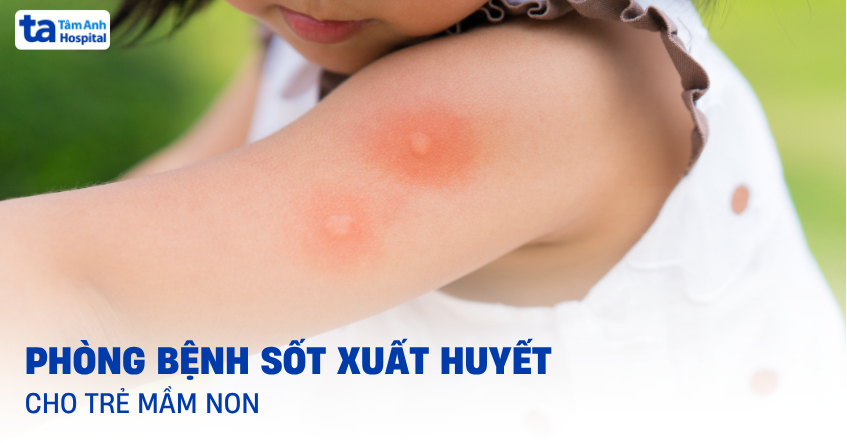 Hướng dẫn phòng bệnh sốt xuất huyết cho trẻ mầm non theo BYT