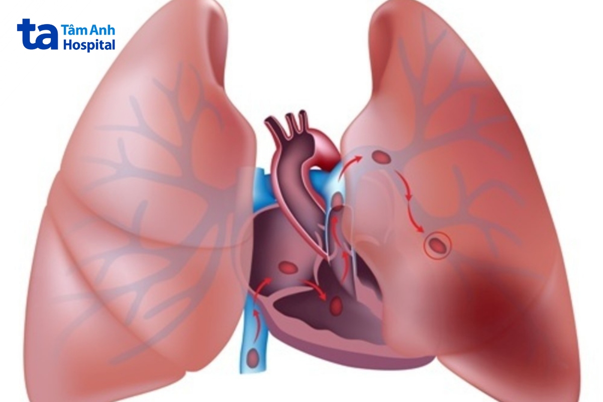 sling động mạch phổi là dị tật bẩm sinh