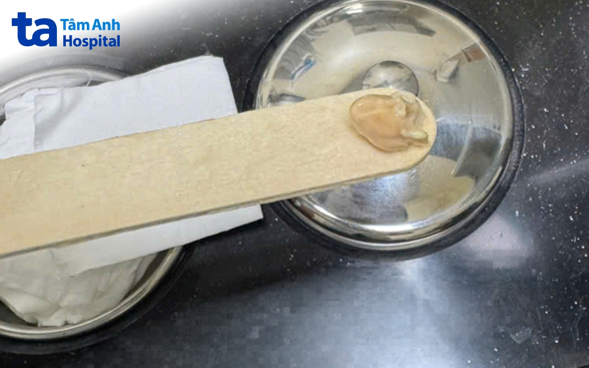 sỏi amidan của bệnh nhân