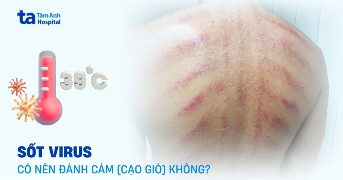 Giải đáp: Sốt virus có nên đánh cảm không?