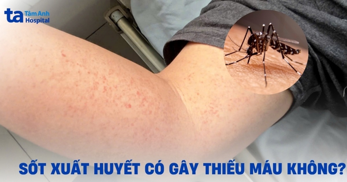 Sốt xuất huyết có gây thiếu máu không? Có nên uống sắt?