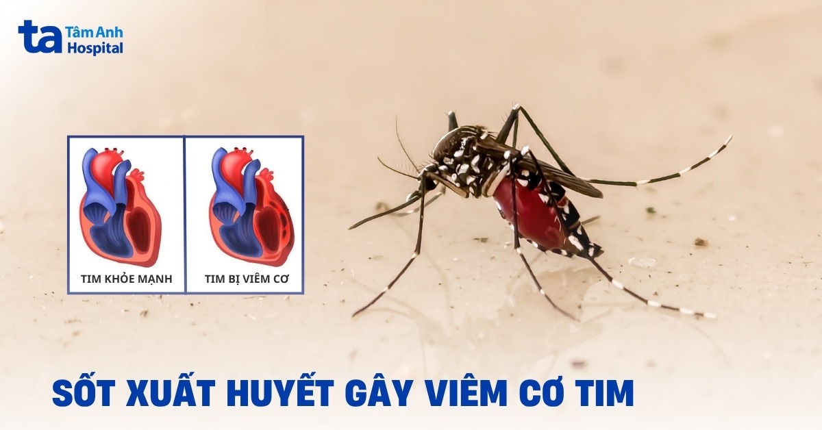 Sốt xuất huyết gây viêm cơ tim: Khi nào cần thận trọng?