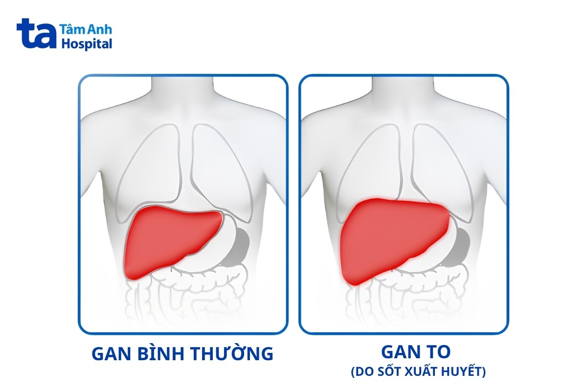 gan to và gan bình thường
