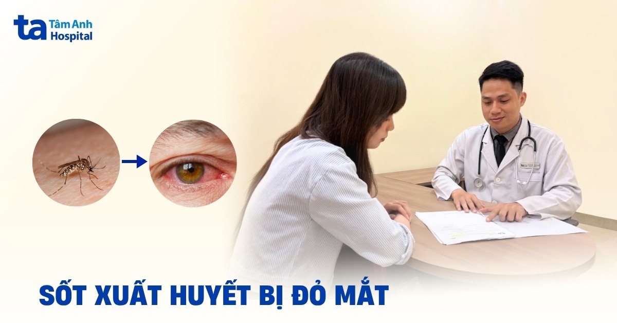 Bị sốt xuất huyết mắt đỏ nên xử trí ra sao?