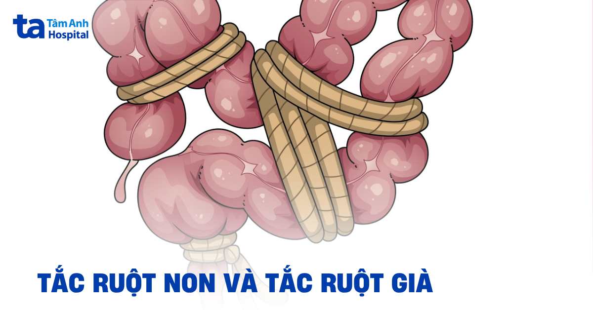 Làm sao phân biệt tắc ruột non và tắc ruột già?