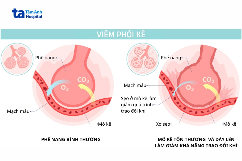 Tình Trạng Thành Phế Nang Dày Lên Có Thể Khiến Việc Trao Đổi Khí Vào Mạch Máu Khó Khăn Hơn
