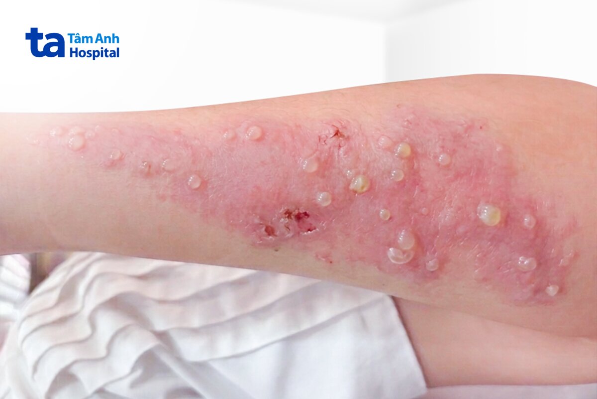 tình trạng tổn thương da của người bệnh