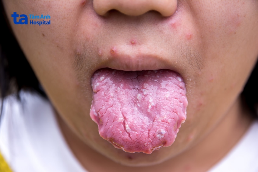 Tổn thương bất thường trên lưỡi và vùng quanh miệng.
