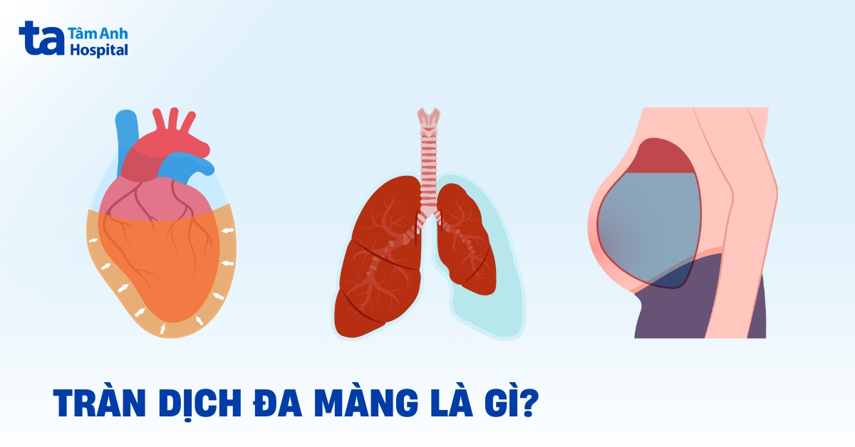 Tràn dịch đa màng là gì? Xuất hiện ở đâu và ảnh hưởng thế nào?