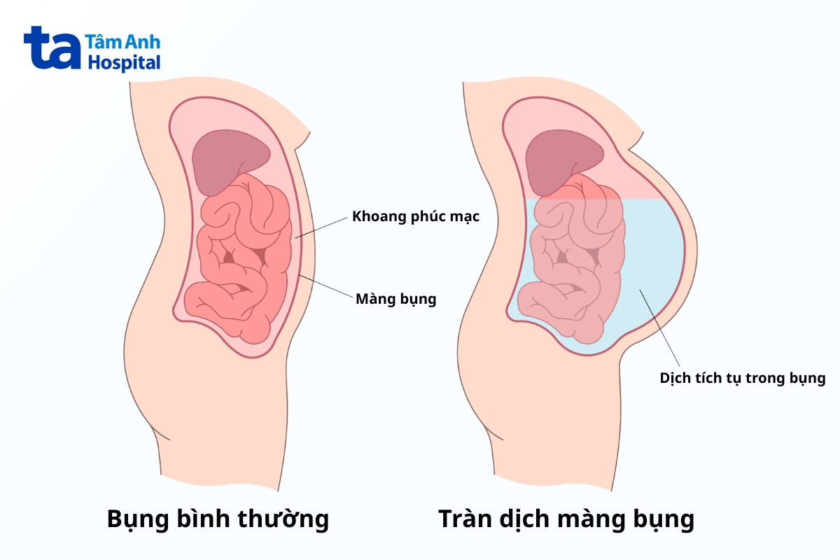 tràn dịch màng bụng là tình trạng tích tụ dịch bất thường trong khoang giữa hai lớp phúc mạc (màng bụng)