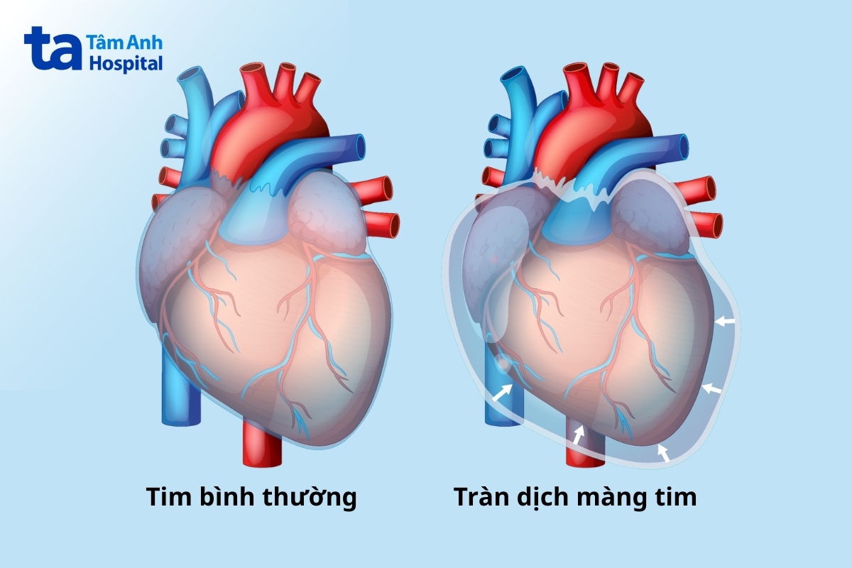 tràn dịch màng tim là tình trạng chất lỏng tích tụ quá mức giữa hai lớp màng bao quanh tim