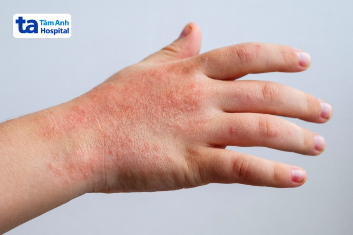 trẻ bị viêm da virus