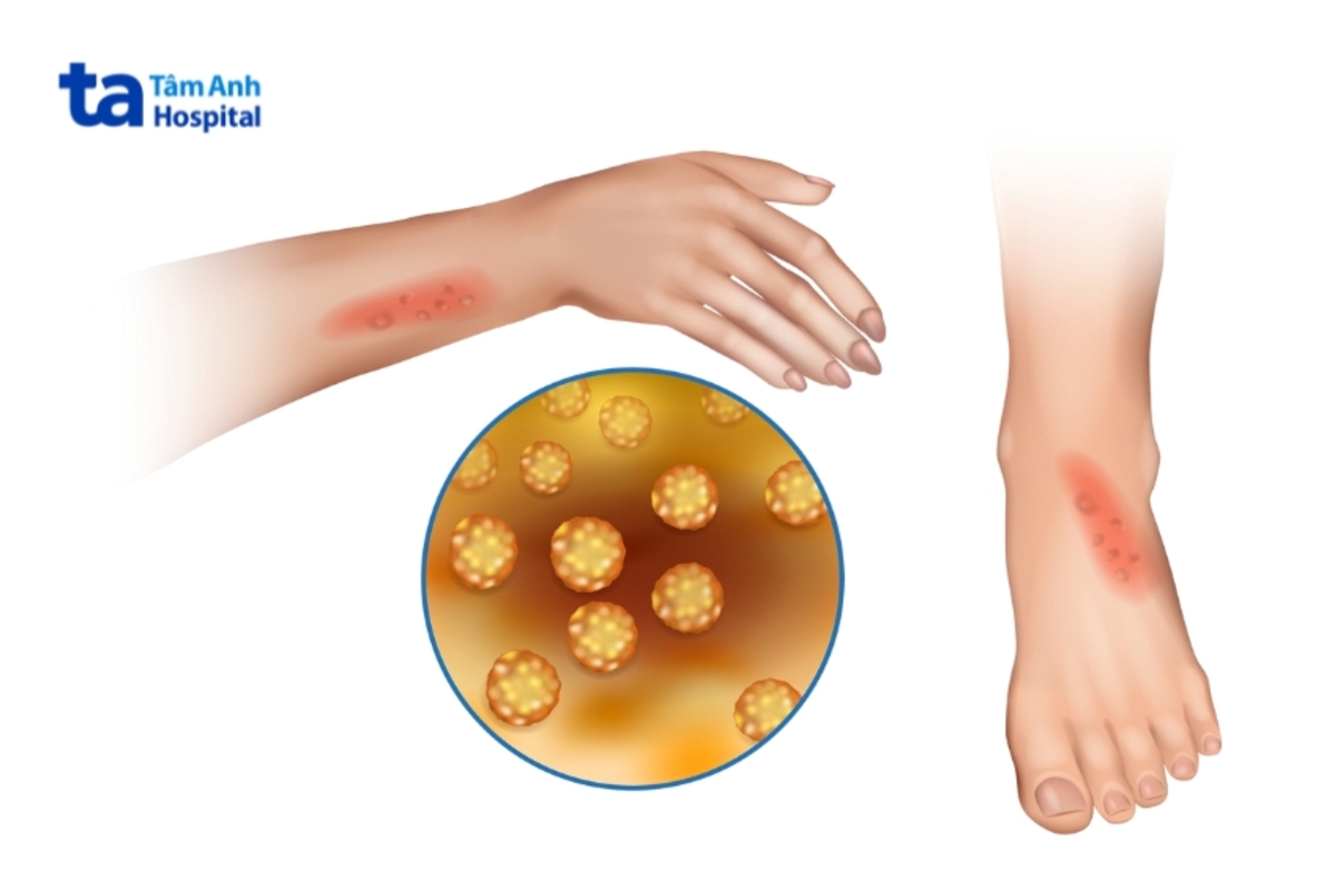 triệu chứng nhiễm mrsa