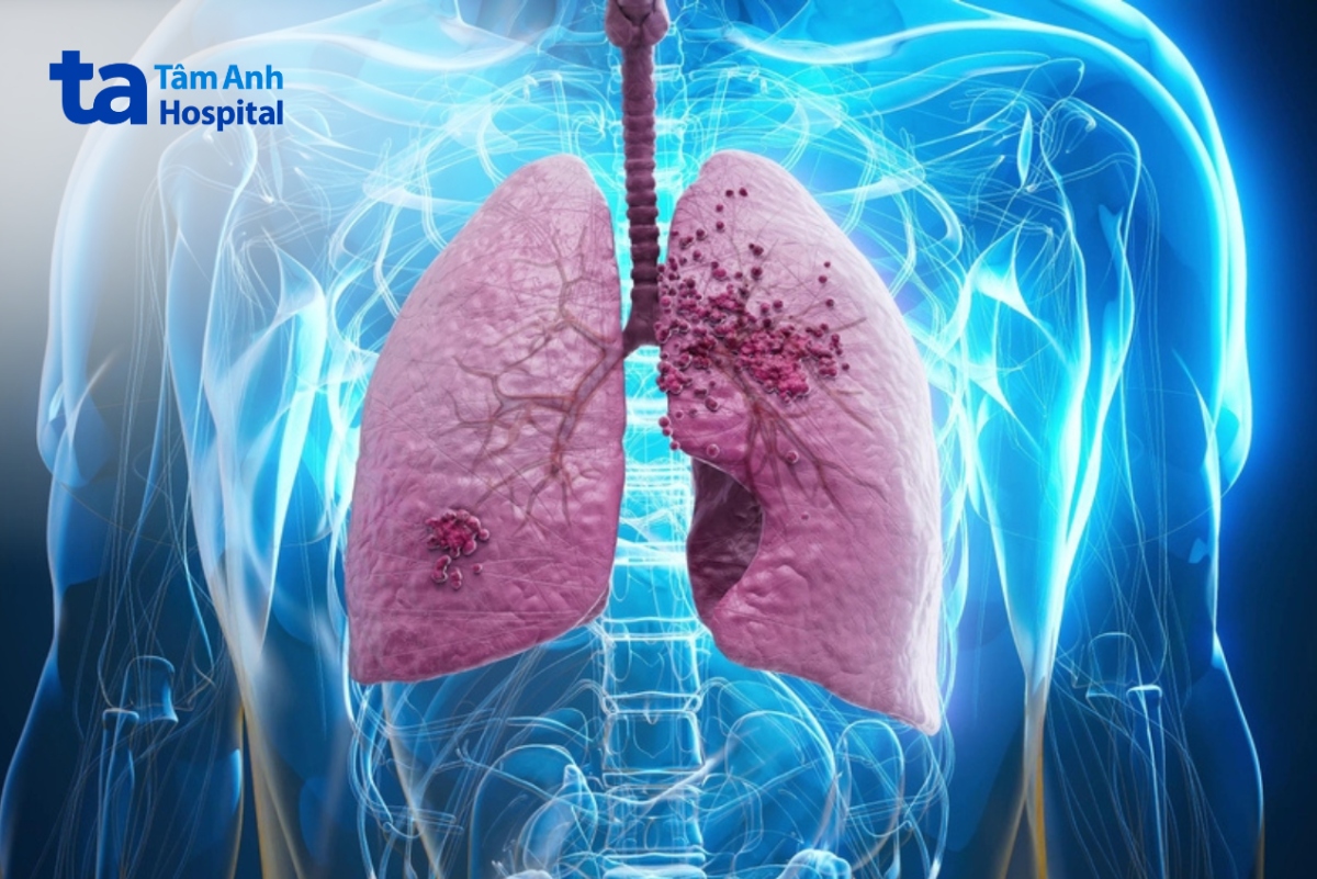 Các Thông Tin Về U Thần Kinh Nội Tiết Ở Phổi U Carcinoid Không Điển Hình