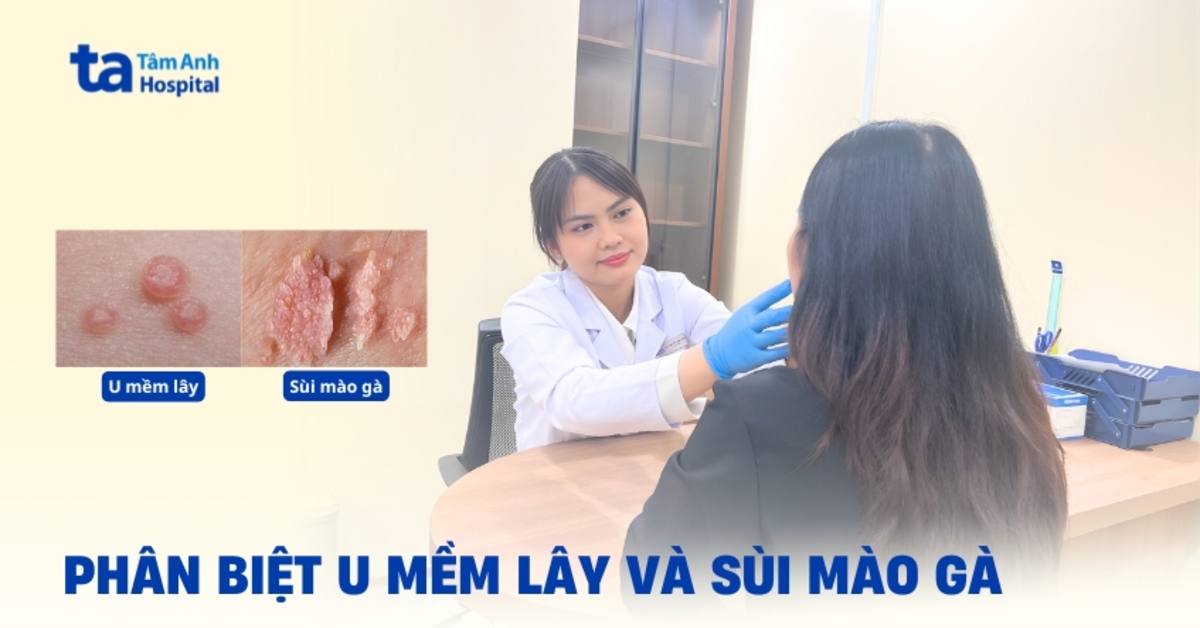 Bảng phân biệt u mềm lây và sùi mào gà chi tiết