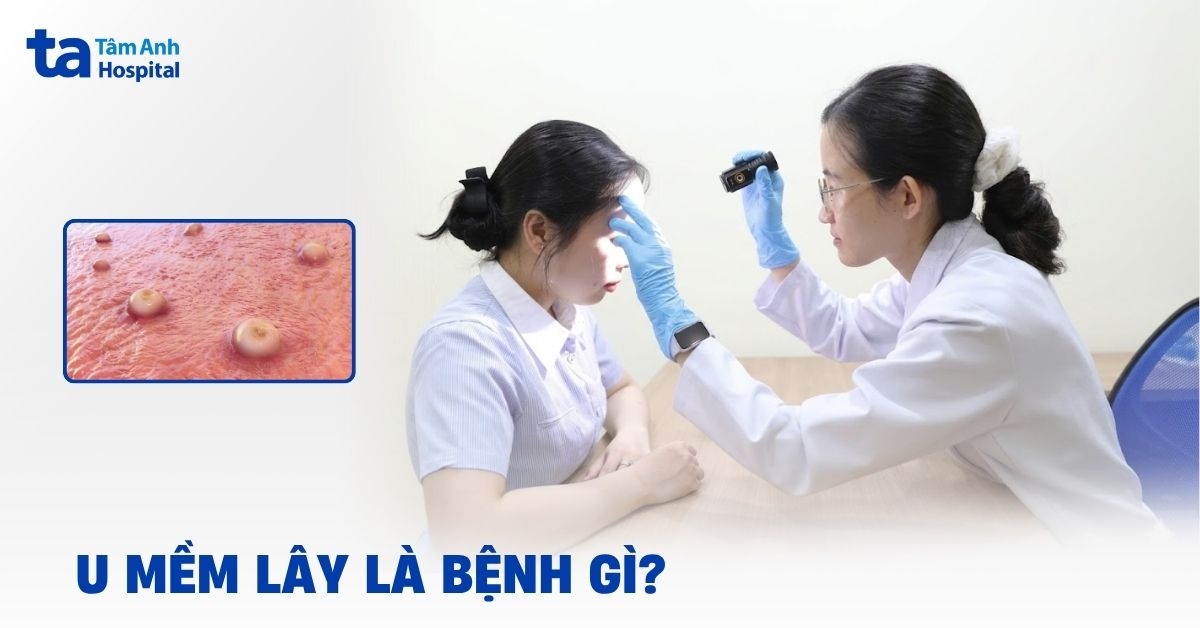 U mềm lây: Nguyên nhân, triệu chứng, điều trị, phòng ngừa