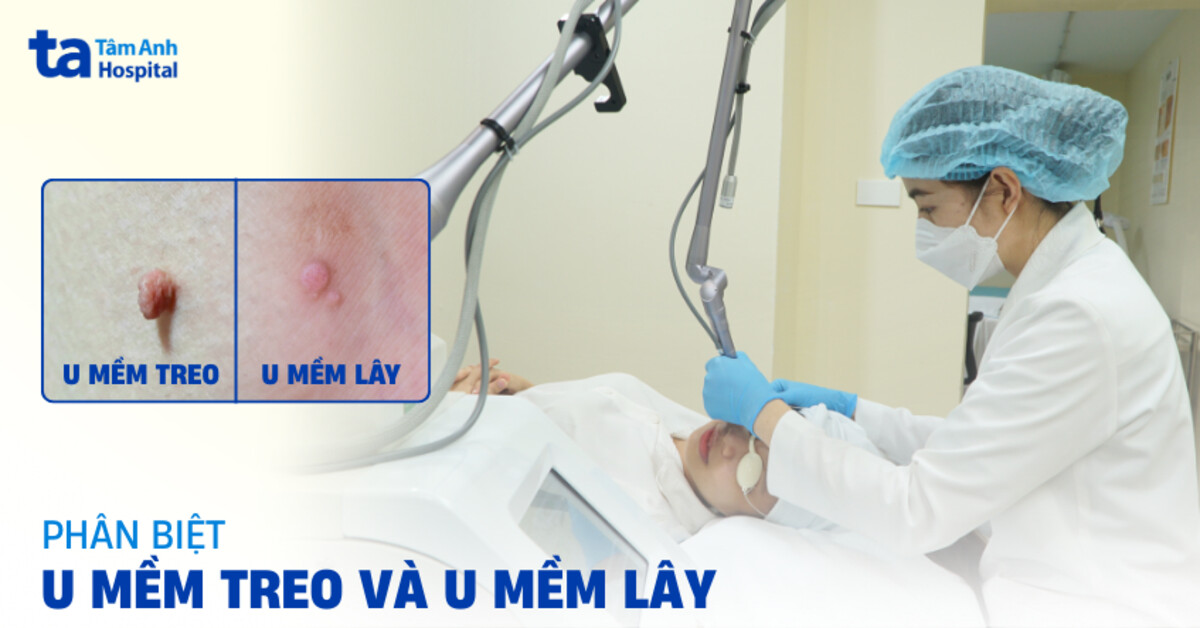 Bảng phân biệt u mềm treo và u mềm lây