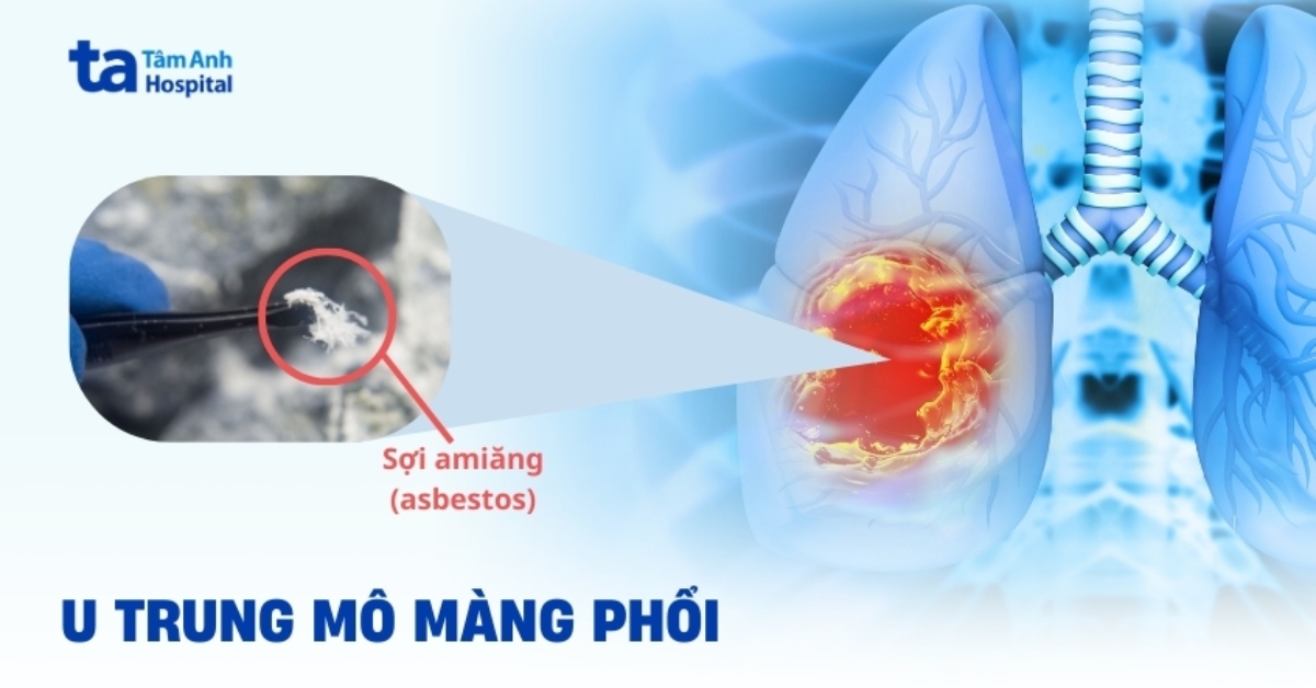 U trung mô màng phổi là gì? Dấu hiệu, giai đoạn và cách điều trị