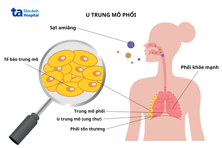 u trung mô màng phổi là ung thư ác tính