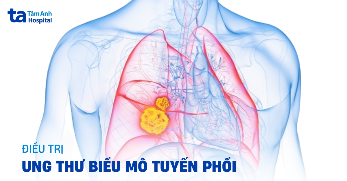 Ung Thư Biểu Mô Tuyến Phổi