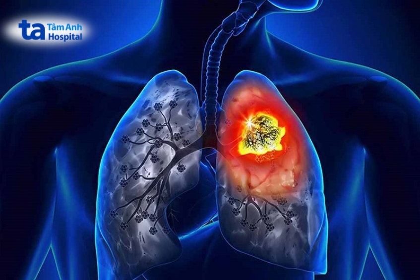 Ung Thư Phổi Nguyên Phát Khởi Phát Ngay Tại Mô Phổi Hoặc Đường Phế Quản