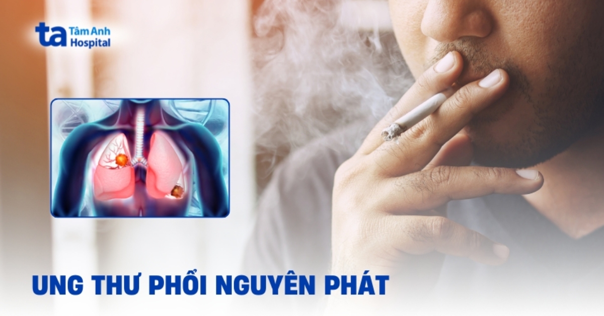 Ung Thư Phổi Nguyên Phát