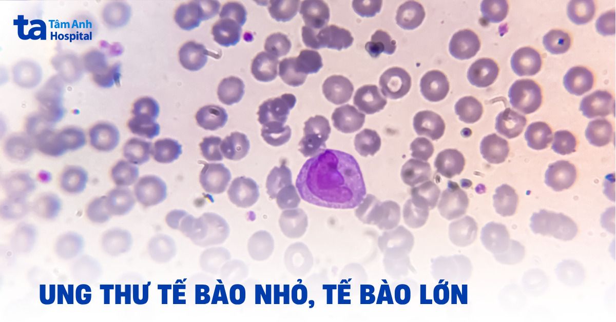 Tìm hiểu về ung thư tế bào nhỏ, tế bào lớn