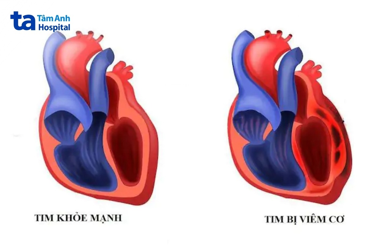 tim khỏe mạnh và tim bị viêm