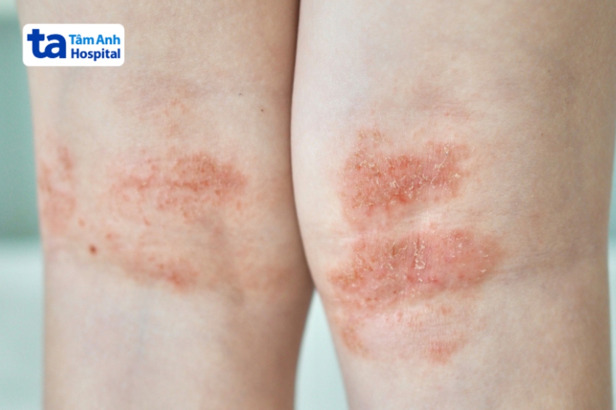 viêm da cơ địa ở nếp gấp