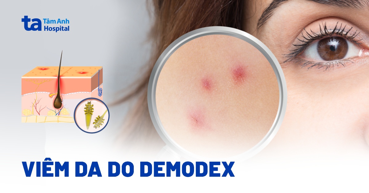 Nhận biết viêm da Demodex và cách điều trị