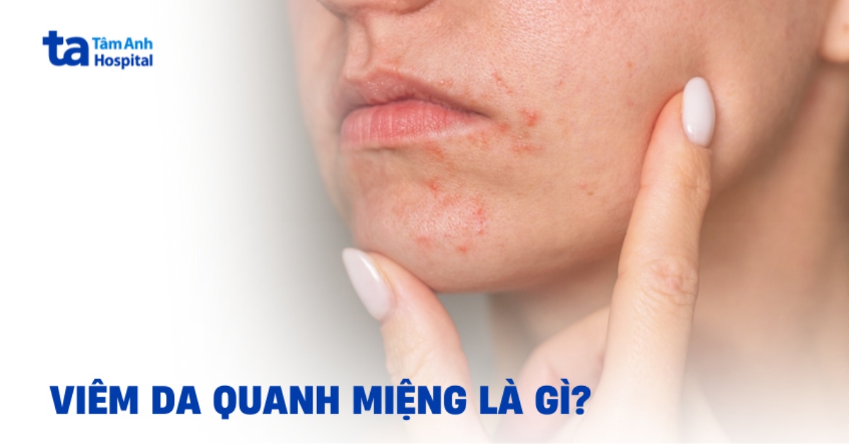 Nhận biết viêm da quanh miệng và cách xử lý hiệu quả