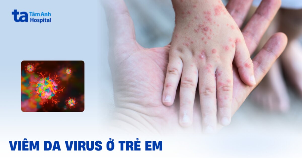 Viêm da virus ở trẻ em: Nhận biết sớm để phòng ngừa