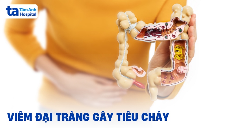 Viêm đại tràng gây tiêu chảy có thể kiểm soát được không?