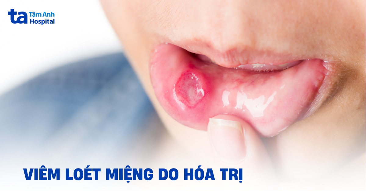 Nhận biết viêm loét miệng do hóa trị ở người ung thư
