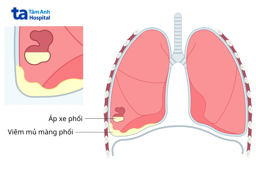 Viêm Mủ Màng Phổi Xuất Hiện Sau Viêm Phổi, Áp Xe Phổi Hoặc Khi Vi Khuẩn Từ Ổ Nhiễm Trùng Lân Cận Lan Sang