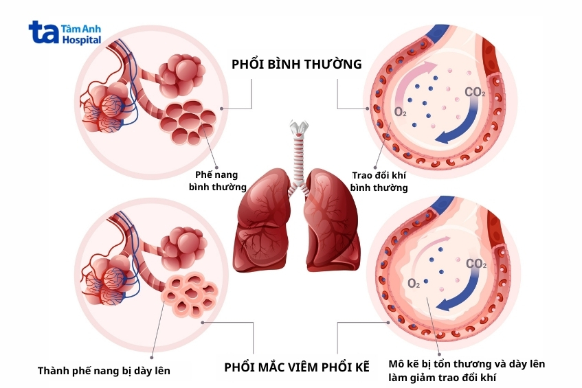 Viêm Phổi Kẽ Làm Phế Nang Dày Lên, Giảm Khả Năng Trao Đổi Khí Tại Phế Nang