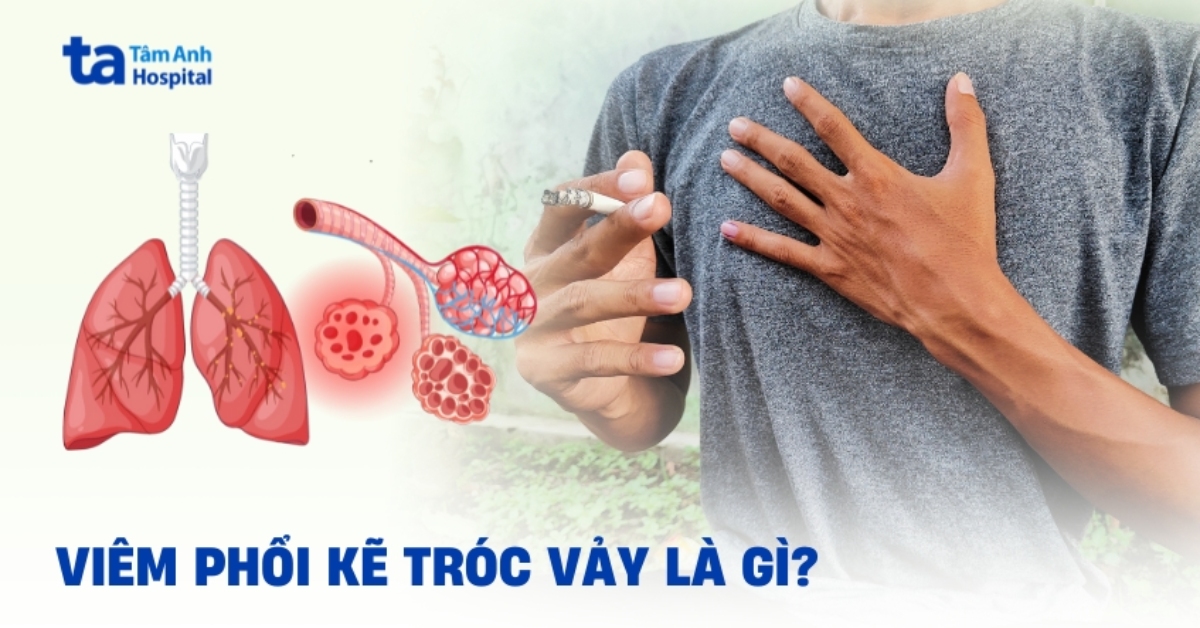 Viêm Phổi Kẽ Tróc Vảy
