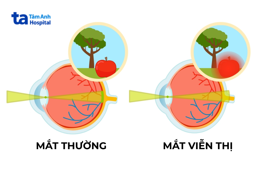 viễn thị bẩm sinh là gì