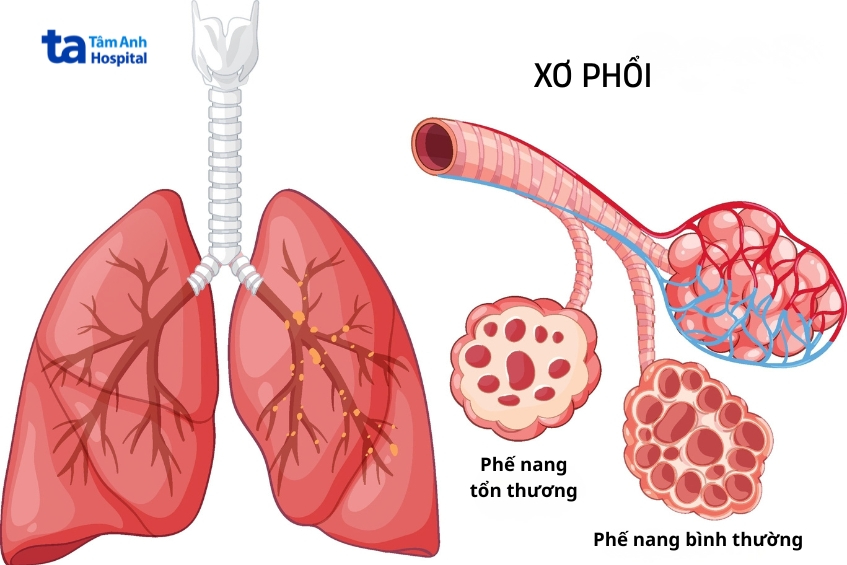 Xơ Phổi Là Tình Trạng Mô Phổi Tổn Thương, Dày Cứng Và Hình Thành Mô Sẹo