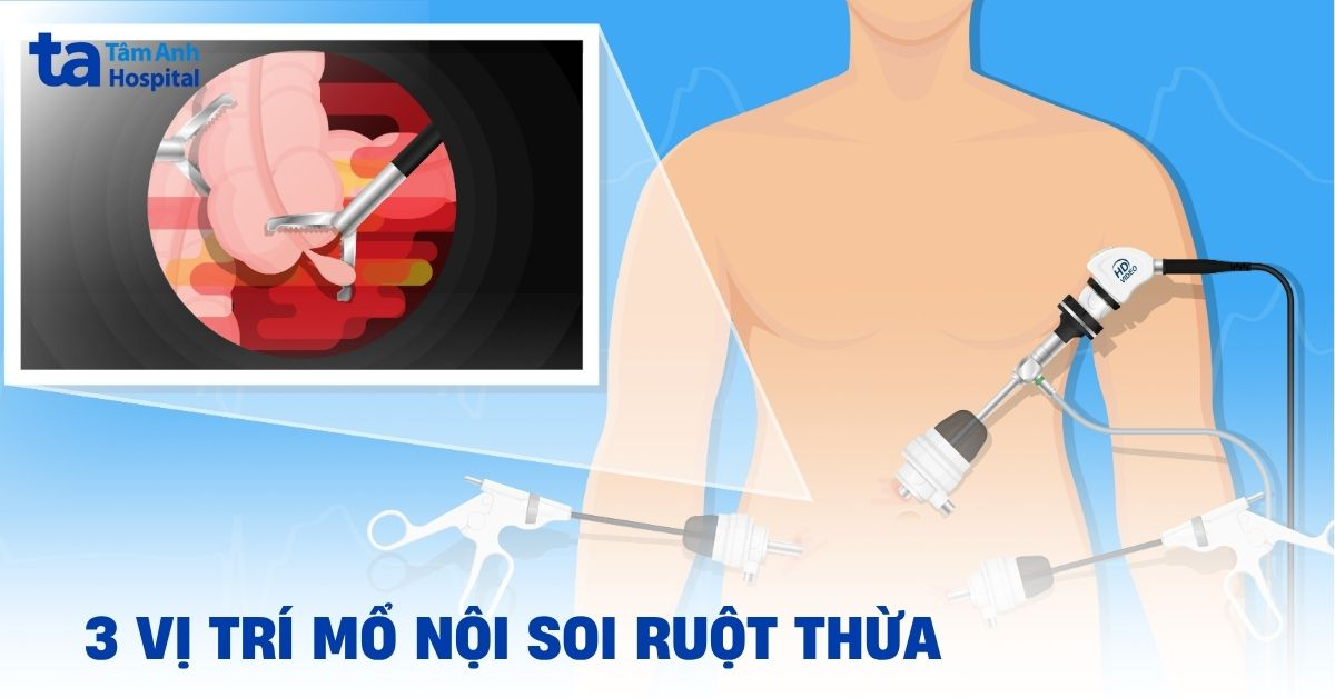3 vị trí mổ nội soi ruột thừa: Quy trình và ý nghĩa