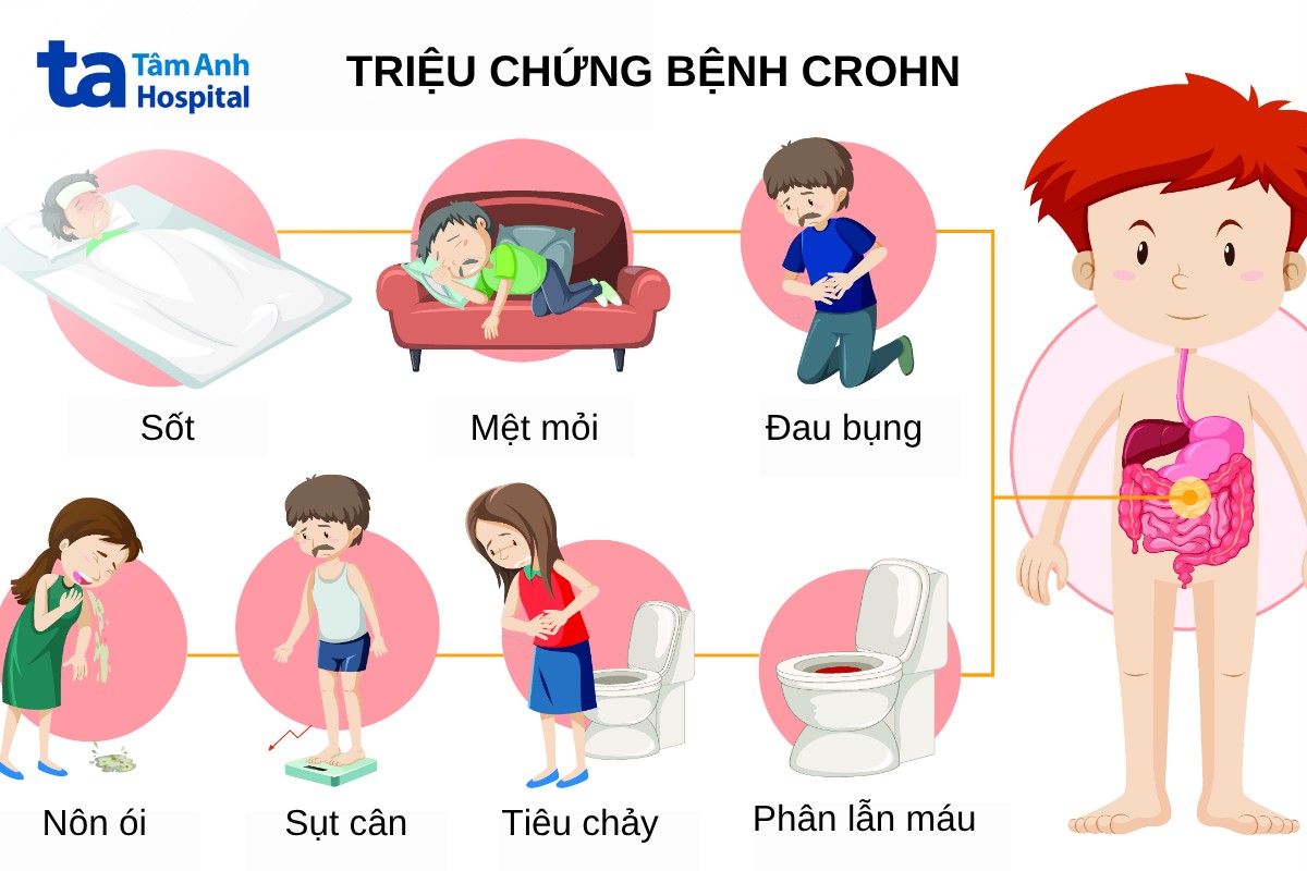 Ai Dễ Bị Mắc Bệnh Crohn