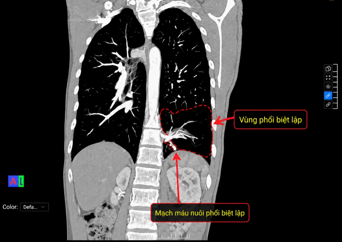 ảnh chụp ct phổi cho thấy vùng phổi biệt lập ở thùy dưới phổi trái, mạch máu nuôi phổi biệt lập xuất phát từ động mạch chủ bụng