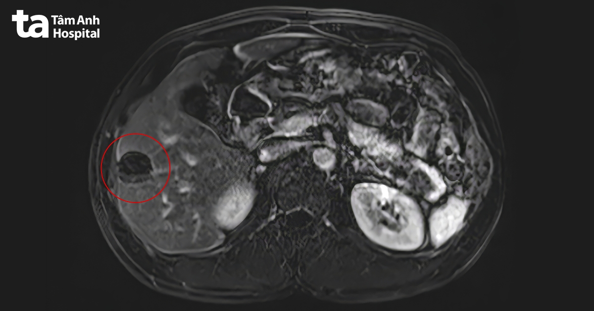 ảnh chụp mri cho thấy tổn thương gan