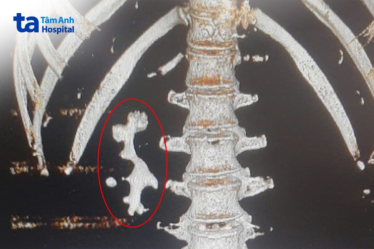ảnh chụp ct lấp kín bể thận
