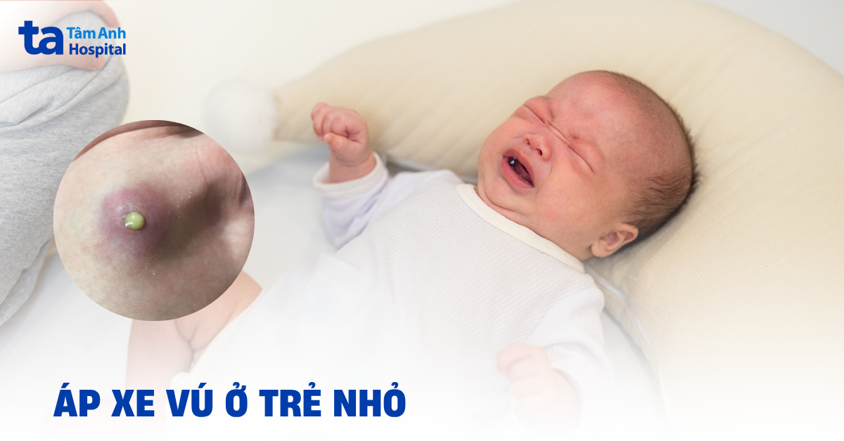 Áp xe vú ở trẻ nhỏ có ngăn ngừa từ sớm được không?