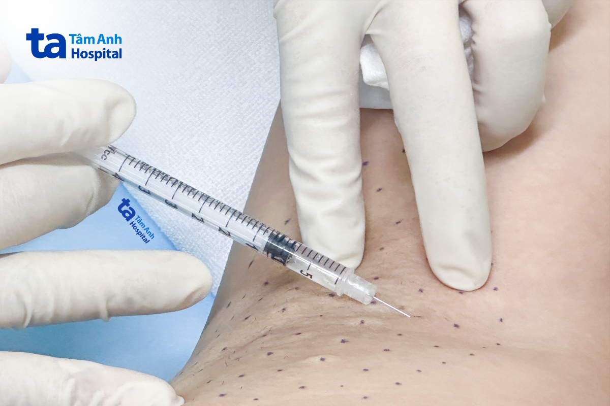 bác sĩ tiêm botox điều trị tăng tiết mồ hôi nách cho chị hằng