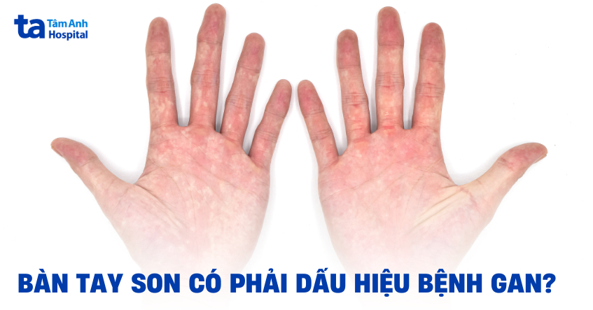 Bàn tay son có phải dấu hiệu bệnh gan?